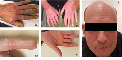 The Role of Oxidative Stress in the Development of Systemic Sclerosis Related Vasculopathy